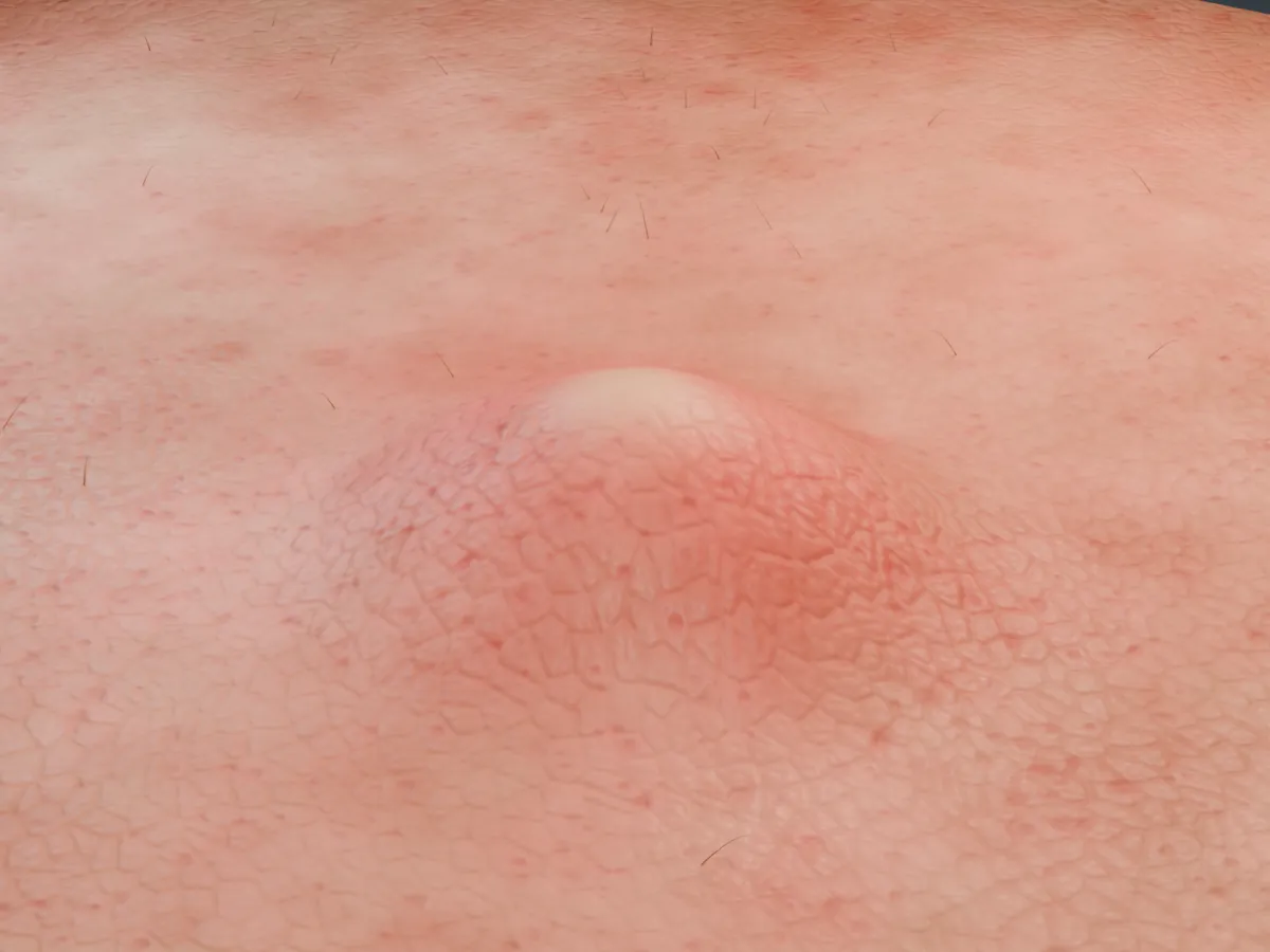 A Blender render of the skin patch: a raised, pale-headed lesion on reddened skin with pores, fine skin lines and short hairs.